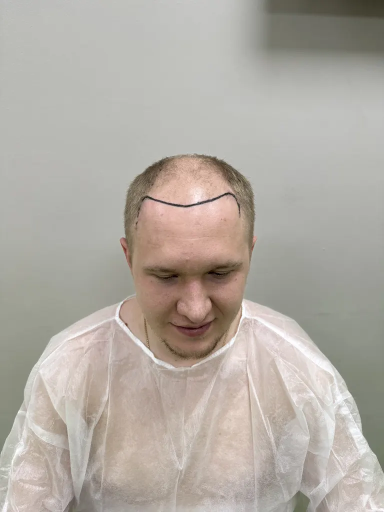 До операции