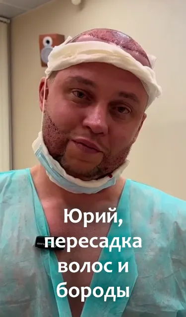 Юрий — пересадка волос и бороды